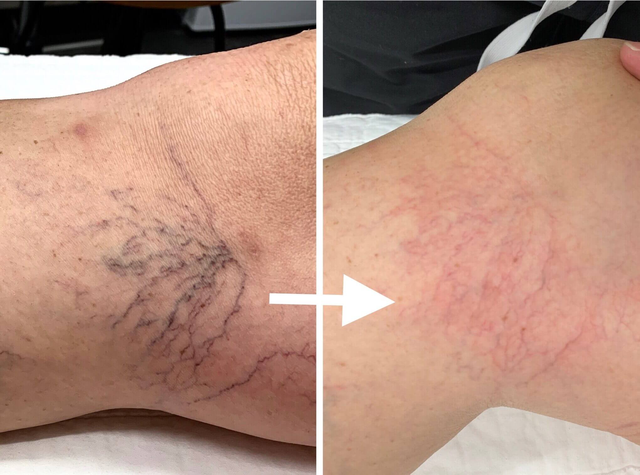 Laser Spider Vein Removal & Therapy Treatment Rochester MN